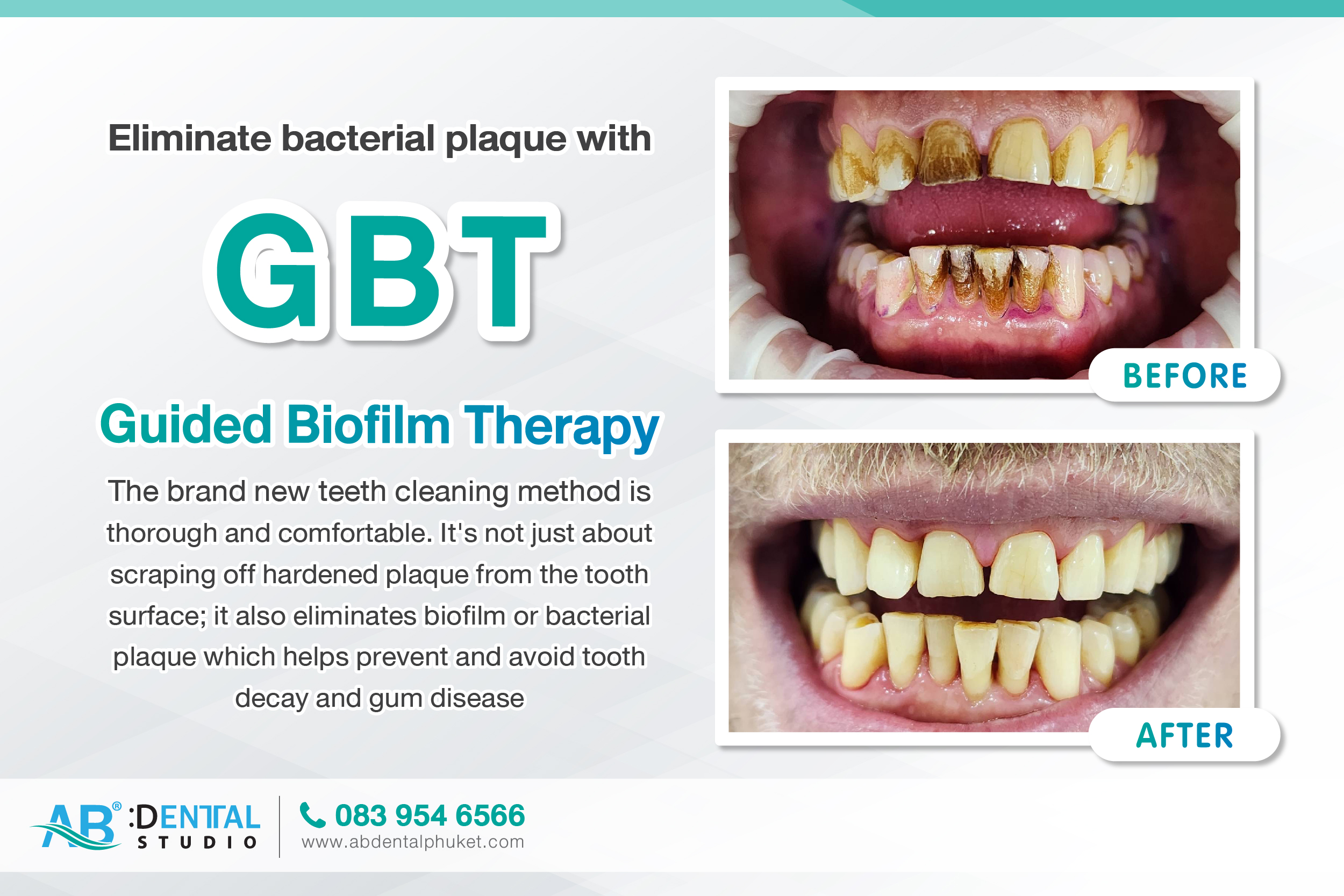 Guided Biofilm Therapy clinic,clinic phuket,gbt clinic,gbt,Guided Biofilm Therapy,dental phuket,ab dental phuket,ab dental