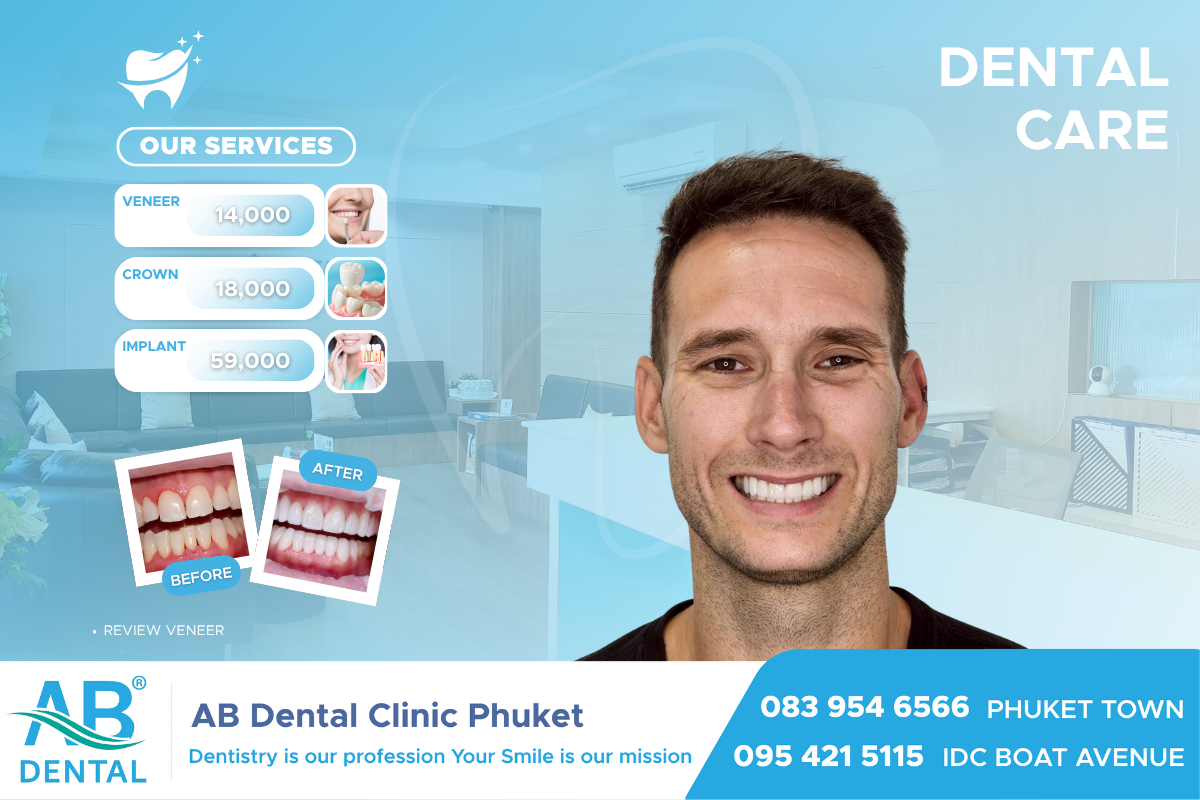 dental veneer, veneer dental, at home dental veneer kit, china dental outsourcing dental veneer, dental veneer cost, dental veneer Patong, dental veneer Thailand, dental veneer design, what is veneer dental, dental veneer perth, veneer dental cost, dental veneer clearwater, fridley dental veneer, dental veneer adhesive, blaine dental veneer, dental veneer prices, dental veneer meaning, veneer dental services, dental veneer dentists gatl