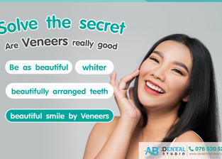 Solve the secret! Are Veneers really good?? Be as beautiful as possible, whiter, beautifully arranged teeth, beautiful smile by Veneers.