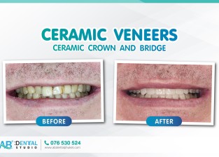Ceramic veneers, Ceramic crown, and bridge at AB Dental Clinic Phuket