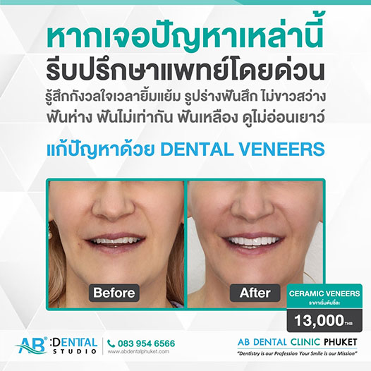 คลินิกทันตกรรม,คลินิกจัดฟัน, คลินิก จัด ฟัน ภูเก็ต, คลินิกทำฟัน ภูเก็ต, dental clinic, dental clinic phuket, phuket dental clinic, dental clinic near me, จัด ฟัน invisalign, dental veneer, ทําฟันปลอมที่ไหนดี, filling teeth, invisalign, crowns dental, ฟันปลอม, ฟอกสีฟัน, ฟอกฟันขาว, teeth whitening, รักษารากฟัน