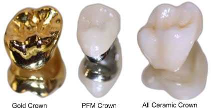 คลินิกทันตกรรม,คลินิกจัดฟัน, คลินิก จัด ฟัน ภูเก็ต, คลินิกทำฟัน ภูเก็ต, dental crown, ceramic crown, porcelain crown, ceramic crown, same-day crown, one visit crown, what is a dental crown, crown dentists, dentist for crowns, crowns in teeth, dental veneers, ceramic veneers, porcelain veneers, dental veneers design, dental clinic Phuket, Phuket dental clinic, clinic dental, class one dental clinic, teeth filling, filling teeth, root canal