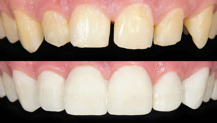 ab dental clinic, ab dental clinic phuket, ab dental phuket,dental phuket, dental clinic, clinic phuket, dental bonding, dental bonding phuket, bonding phuket, bonding dental, dental bonding in phuket