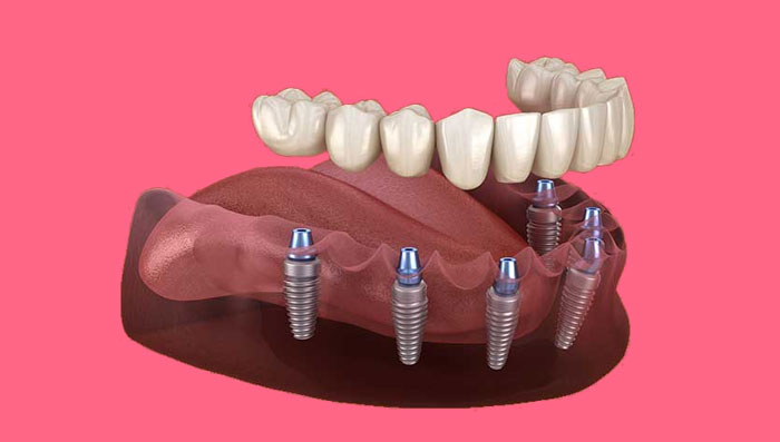 คลินิกทันตกรรม,คลินิกจัดฟัน, คลินิก จัด ฟัน ภูเก็ต, คลินิกทำฟัน ภูเก็ต, dental clinic, dental clinic phuket, phuket dental clinic, dental clinic near me, Dental Sealant คือ, ใส่รากฟันเทียมราคาเท่าไร, รากฟันเทียมราคาถูก, รากฟันเทียม ยี่ห้อไหนดี, Dental Implant คือ