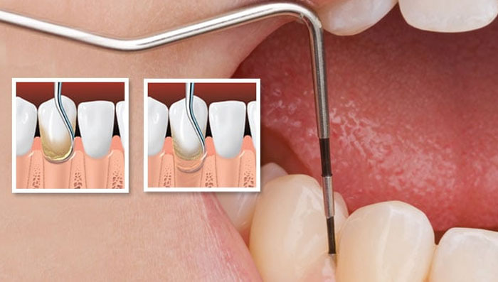ab dental clinic, ab dental clinic phuket, ab dental phuket,dental phuket, dental clinic, clinic phuket, general dentistry phuket, general dentistry, Periodontal Phuket, Periodontal, Dental Scaling & Polishing Phuket, Scaling & Polishing Phuket, Dental Scaling & Polishing, Scaling & Polishing, Scaling Phuket, Polishing Phuket, Scaling, Polishing