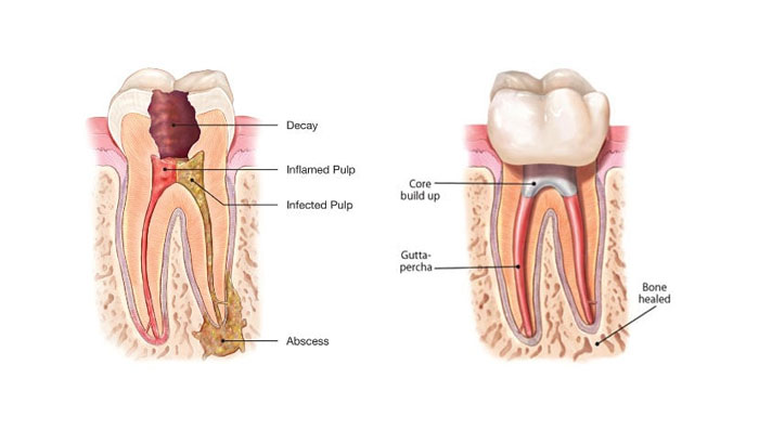 ab dental clinic, ab dental clinic phuket, ab dental phuket,dental phuket, dental clinic, clinic phuket, oral surgery, dental root canal treatment phuket, dental root canal treatment, root canal treatment phuket, dental root canal treatment in phuket, root canal treatment