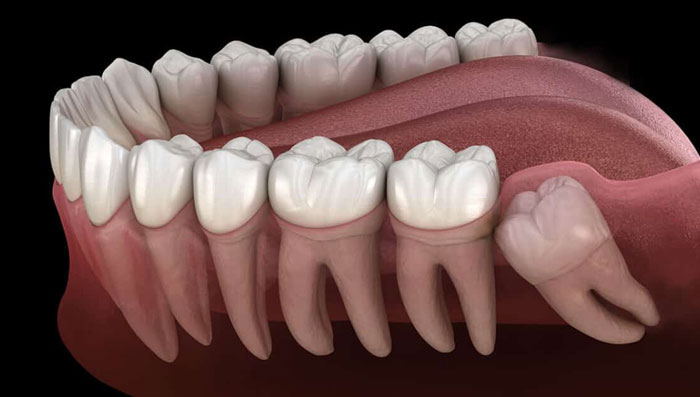 คลินิกทันตกรรม,คลินิกจัดฟัน, คลินิก จัด ฟัน ภูเก็ต, คลินิกทำฟัน ภูเก็ต, dental clinic, dental clinic phuket, phuket dental clinic, dental clinic near me, วิธีถอนฟัน, ถอนฟันกราม, ถอนฟันกรามผุ, ถอนฟันกรามผุ, ถอนฟันราคา