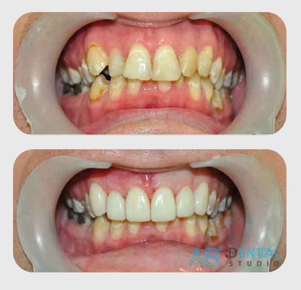 คลินิกทันตกรรม,คลินิกจัดฟัน, คลินิก จัด ฟัน ภูเก็ต, คลินิกทำฟัน ภูเก็ต, dental clinic, dental clinic phuket, phuket dental clinic, dental clinic near me, จัด ฟัน invisalign, dental veneer, ทําฟันปลอมที่ไหนดี, filling teeth, invisalign, crowns dental, ฟันปลอม, ฟอกสีฟัน, ฟอกฟันขาว, teeth whitening