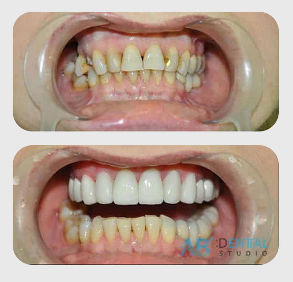 คลินิกทันตกรรม,คลินิกจัดฟัน, คลินิก จัด ฟัน ภูเก็ต, คลินิกทำฟัน ภูเก็ต, dental clinic, dental clinic phuket, phuket dental clinic, dental clinic near me, จัด ฟัน invisalign, dental veneer, ทําฟันปลอมที่ไหนดี, filling teeth, invisalign, crowns dental, ฟันปลอม, ฟอกสีฟัน, ฟอกฟันขาว, teeth whitening