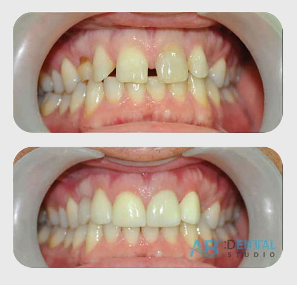 คลินิกทันตกรรม,คลินิกจัดฟัน, คลินิก จัด ฟัน ภูเก็ต, คลินิกทำฟัน ภูเก็ต, dental clinic, dental clinic phuket, phuket dental clinic, dental clinic near me, จัด ฟัน invisalign, dental veneer, ทําฟันปลอมที่ไหนดี, filling teeth, invisalign, crowns dental, ฟันปลอม, ฟอกสีฟัน, ฟอกฟันขาว, teeth whitening